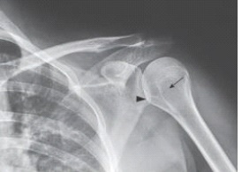 What projection,position,and anatomy of interest in the image below is demonstrated?   A)  AP projection of the shoulder in external rotation B)  AP projection of the shoulder in internal rotation C)  AP projection of the shoulder in neutral position D)  AP oblique projection of the shoulder (Grashey) 
