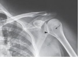 The anatomy labeled in the image below by the arrowhead is the:   A)  acromion. B)  coracoid process. C)  glenoid. D)  lesser tubercle.