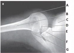 What anatomy is labeled as letter A in the image below?   A)  Greater tubercle B)  Lesser tubercle C)  Acromion D)  Coracoid process