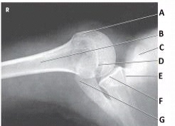 What anatomy is labeled as letter C in the image below?   A)  Greater tubercle B)  Lesser tubercle C)  Acromion D)  Coracoid process