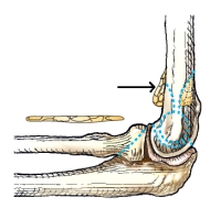 Which fat pad is identified by the arrow in this figure?   A)  Anterior B)  Posterior C)  Coronoid D)  Supinator