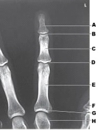 What projection of the third digit is demonstrated in the figure above?   A)  PA B)  PA oblique C)  Mediolateral D)  Lateromedial
