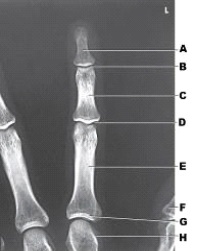 What anatomy of the third digit is labeled as letter D in the figure above?   A)  Distal IP joint B)  Proximal IP joint C)  Metacarpophalangeal joint D)  Carpometacarpal joint