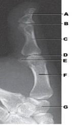 Which projection of the first digit is demonstrated in the figure above?   A)  PA B)  PA oblique C)  Mediolateral D)  Lateromedial