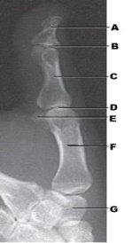 The anatomy labeled as letter D in the figure above is the _____ joint.   A)  proximal IP B)  distal IP C)  metacarpophalangeal D)  carpometacarpal