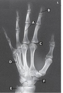Letter E in the figure above labels the:   A)  pisiform. B)  ulna. C)  radius. D)  scaphoid.