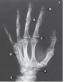 Letter B in the figure above labels the _____ phalanx of the _____ digit.   A)  distal; first B)  distal; second C)  proximal; first D)  first; second