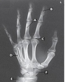 Letter D in the figure above labels the:   A)  first metacarpal. B)  proximal phalanx of the fifth digit. C)  fifth metacarpal. D)  proximal phalanx of the first digit.