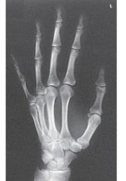 What projection of the hand is demonstrated in the figure above?   A)  PA B)  PA oblique C)  Lateral,fan lateral position D)  Lateral,in extension