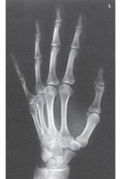 The hand in the figure above was positioned:   A)  with the fingers flexed and resting on the IR. B)  with the fingers extended and parallel with the IR. C)  in radial deviation. D)  supinated.