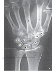 Which bone is labeled as letter E in the figure above?   A)  Capitate B)  Scaphoid C)  Triquetrum D)  Lunate