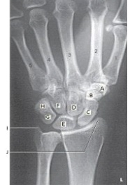 The scaphoid in the figure above is labeled as letter:   A)  A. B)  B. C)  C. D)  H.