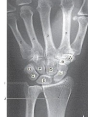 Which bone is labeled as letter B in the figure above?   A)  Capitate B)  Hamate C)  Trapezoid D)  Trapezium
