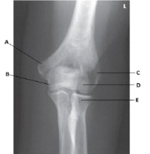 What projection is depicted in the image below?   A)  AP B)  AP oblique in medial rotation C)  AP oblique in lateral rotation D)  Mediolateral