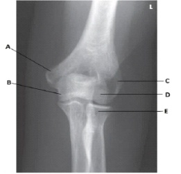 What anatomy is labeled as letter A in the image below?   A)  Lateral epicondyle of the humerus B)  Medial epicondyle of the humerus C)  Coronoid process of the ulna D)  Trochlea