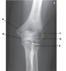 What anatomy is labeled as letter B in the image below?   A)  Lateral epicondyle of the humerus B)  Medial epicondyle of the humerus C)  Coronoid process of the ulna D)  Trochlea