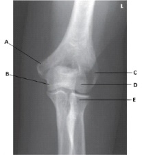 What anatomy is labeled as letter C in the image below?   A)  Lateral epicondyle of the humerus B)  Medial epicondyle of the humerus C)  Coronoid process of the ulna D)  Trochlea