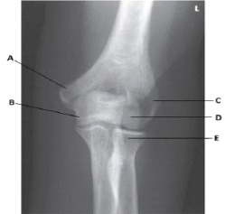 What anatomy is labeled as letter E in the image below?   A)  Radial head B)  Capitulum C)  Coronoid process of ulna D)  Trochlea