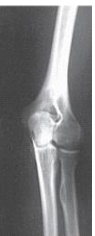 What projection and position is depicted in the image below?   A)  AP,anatomic position B)  AP oblique,lateral rotation position C)  AP oblique,medial rotation position D)  Mediolateral,lateral position