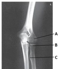 Letter A in the image below labels the:   A)  medial epicondyle of the humerus. B)  capitulum. C)  radial head. D)  trochlea.