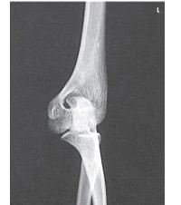 What projection and position is demonstrated in the image below?   A)  AP B)  AP oblique,medial rotation C)  AP oblique,lateral rotation D)  AP distal humerus,partial flexion position