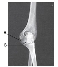 What anatomy is labeled as letter A in the image below?   A)  Capitulum B)  Lateral epicondyle of humerus C)  Trochlea D)  Coronoid process of ulna