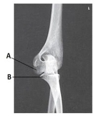 What anatomy is labeled as letter B in the image below?   A)  Capitulum B)  Lateral epicondyle of humerus C)  Trochlea D)  Coronoid process of ulna