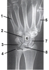 What anatomy is labeled as number 2 in the image below?   A)  Lunate B)  Pisiform C)  Hamate D)  Capitate