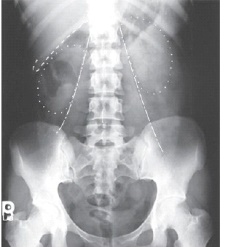 Which structures are outlined with dots in this AP image of the abdomen?   A)  Stomach B)  Liver C)  Kidneys D)  Psoas muscles