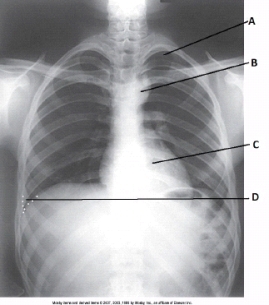 What anatomy is labeled as letter A in the image below?   A)  Apex of right lung B)  Apex of left lung C)  Costophrenic angle of right lung D)  Costophrenic angle of left lung