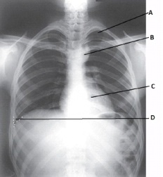 What anatomy is labeled as letter B in the image below?   A)  Apex of right lung B)  Apex of left lung C)  Aortic arch D)  Thymus gland