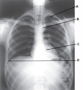 What anatomy is labeled as letter C in the image below?   A)  Thymus gland B)  Heart C)  Lingula D)  Aortic arch