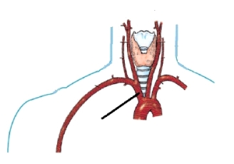 The artery identified in the figure below is the:   A)  brachiocephalic. B)  left subclavian. C)  right subclavian. D)  right common carotid.