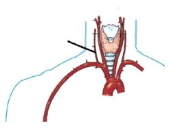 The artery identified in the figure below is the:   A)  left vertebral. B)  right vertebral. C)  right common carotid. D)  left internal carotid.