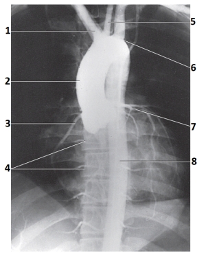 The artery labeled as 3 in this figure is the:   A)  brachiocephalic. B)  right coronary. C)  right intercostal. D)  ascending aorta.