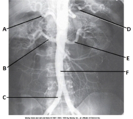 Letter B in the abdominal aortogram image below is the _____ artery.   A)  splenic B)  celiac C)  R renal D)  hepatic