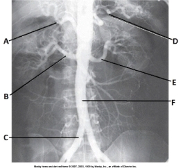 Letter C in the abdominal aortogram image below is the:   A)  R common iliac artery. B)  abdominal aorta. C)  R femoral artery. D)  gonadal artery.