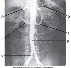 Letter F in the abdominal aortogram image below is the:   A)  abdominal aorta. B)  common iliac artery. C)  superior mesenteric artery. D)  inferior mesenteric artery.