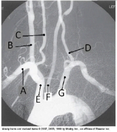 Letter A in the angiographic image of the aortic arch and its branches below is the _____ artery.   A)  innominate (brachiocephalic)  B)  R common carotid C)  R subclavian D)  R vertebral