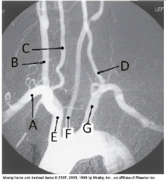 Letter D in the angiographic image of the aortic arch and its branches below is the _____ artery.   A)  innominate (brachiocephalic)  B)  L common carotid C)  L subclavian D)  L vertebral