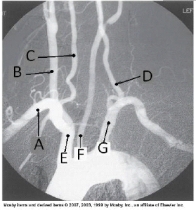 <strong>Letter E in the angiographic image of the aortic arch and its branches below is the _____ artery.  </strong> A) innominate (brachiocephalic) B) L common carotid C) L subclavian D) L vertebral <div style=padding-top: 35px> 