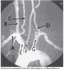 Letter G in the angiographic image of the aortic arch and its branches below is the _____ artery.   A)  innominate (brachiocephalic)  B)  L common carotid C)  L subclavian D)  L vertebral
