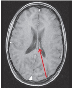The red arrow is pointing to the bright structure within the dark gray structure.What anatomy is indicated by the arrow?   A)  Septum pallucidum B)  Corpus callosum C)  Caudate nucleus D)  Choroid plexus