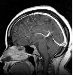 What imaging plane is presented in this image?   A)  Sagittal B)  Axial C)  Oblique D)  Coronal