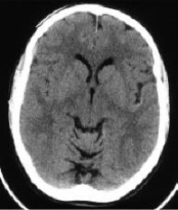 Which imaging modality produced this image?   A)  CT B)  MRI C)  Radiography D)  Ultrasound