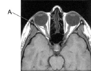 Line A is pointing to the:   A)  optic nerve. B)  pituitary gland. C)  carotid artery. D)  carotid vein.
