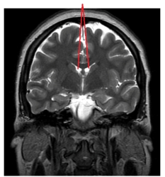 The lines in this image point to the:   A)  pons. B)  third ventricle. C)  cerebellum. D)  lateral ventricles.