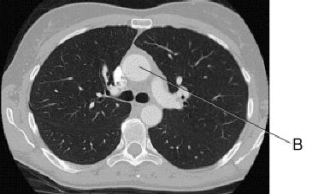 In this cross section of the thorax,line B identifies the:   A)  bronchus. B)  esophagus. C)  ascending aorta. D)  descending aorta.