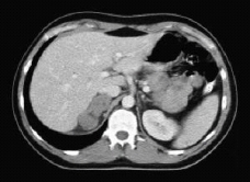 This image is a(n) _____ plane of the _____ abdomen.   A)  axial; upper B)  coronal; upper C)  axial; lower D)  coronal; lower