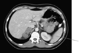The line on this image is pointing to the:   A)  colon. B)  kidney. C)  stomach. D)  spleen.